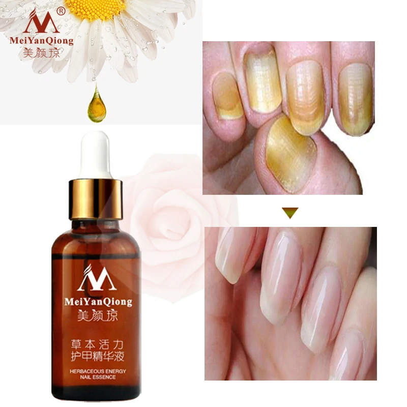 100 Original Meiyanqiong Herbaceous Energy Nail Essence Fungal Nail