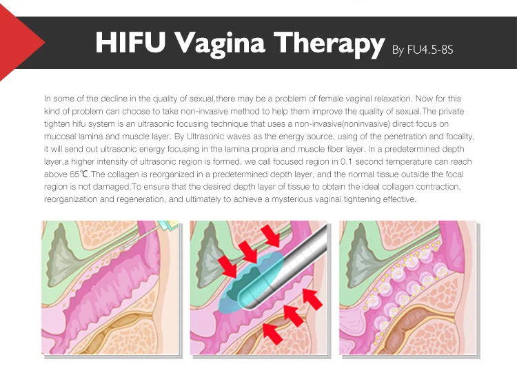 High quality hifu vaginal tightening machine for 3.0 / 4.5 mm private rejuvenation