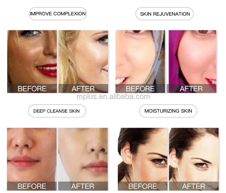 Effectively Oxygen Jet Peel Facial Cleaning Beauty Machine RF Skin Tightening