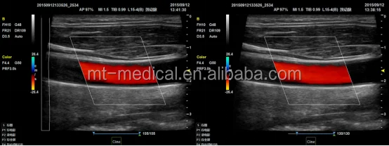 Portable Ultrasonic Diagnostic Devices Type Ultrasound Machine For Pregnancy