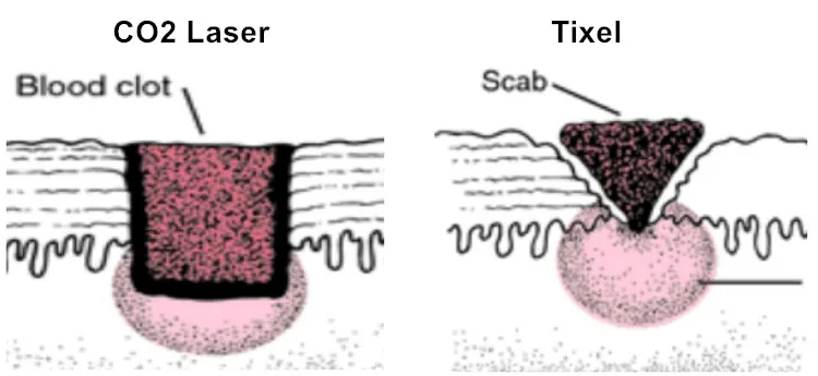 tixel fractional.jpg