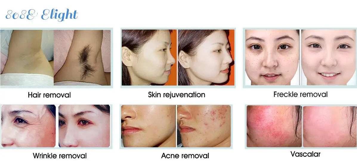 4 in 1 multifunction beauty machine IPL machine diode laser hair removal nd yag  laser rf laser beauty equipment