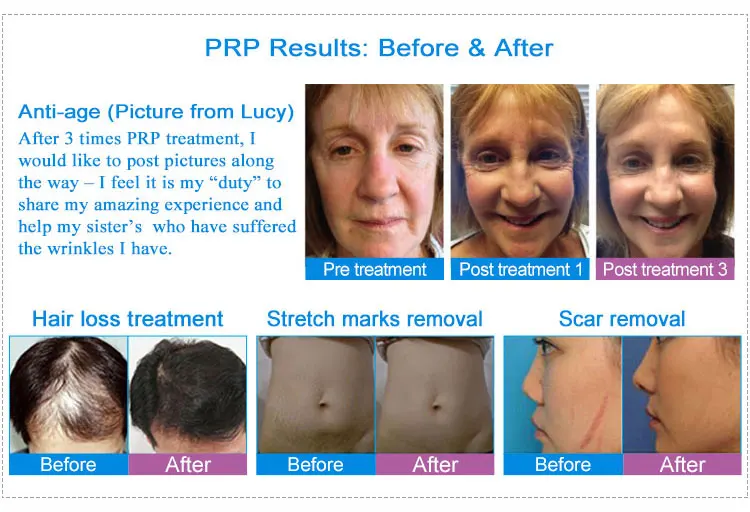 07  PRP result.jpg