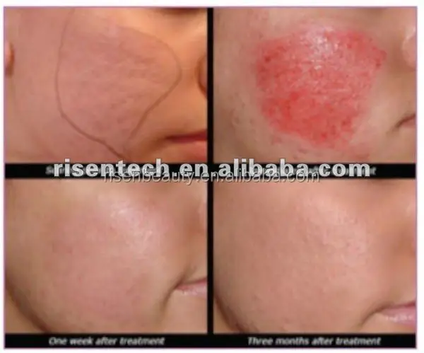 roller skin treatment