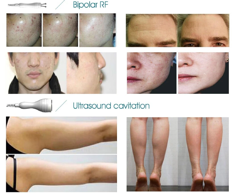 Sanhe high intensity Focused ultrasound hifu slimming Portable HIFU salushape system
