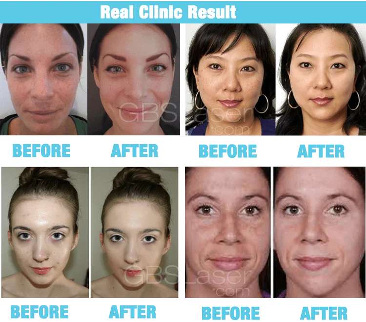 dermabrasion facial