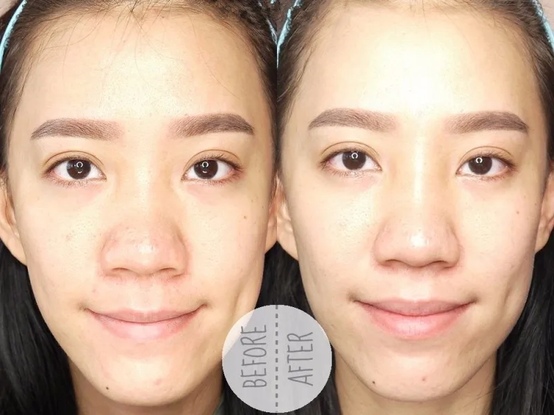 nose reshape without surgery