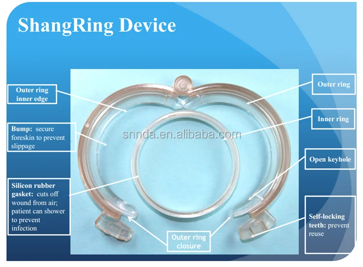 Plastibell Procedure