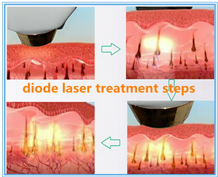 Параметры диодного лазера. Диодный лазер Diode Laser 808 NM. Диод лазер эпиляция. Diode Laser для эпиляции.