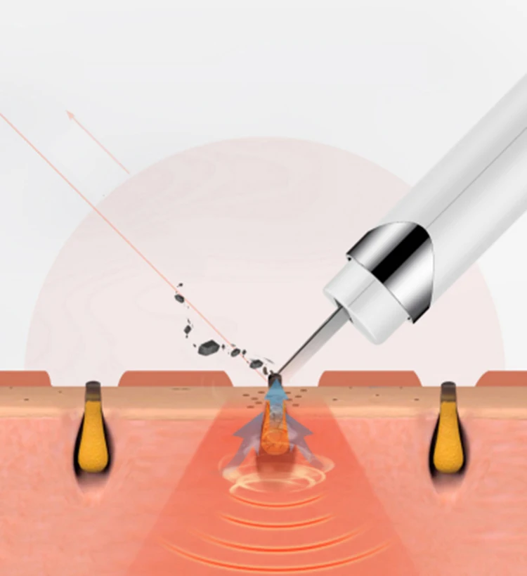 new product Acne And Mole Removal ultrasonic machine cleaner Clean the Skin Remove skin scrubber Beauty Equipment Beauty