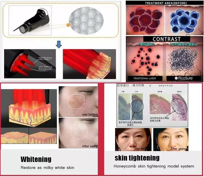 Mini Picosecond Laser Pen For Tattoo Scar Pigment Removal Device