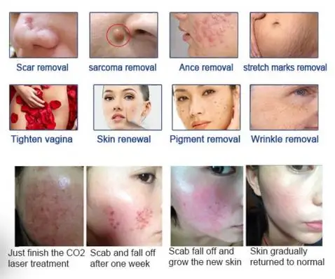 2019 Hot sale co2 fractional laser japan  for scar removal and vagina tightening