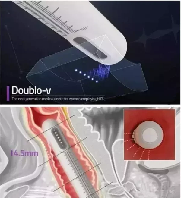Chinese Factory Price Vaginal Tightening Vaginal Rejuvenation Hifu Beauty Machine