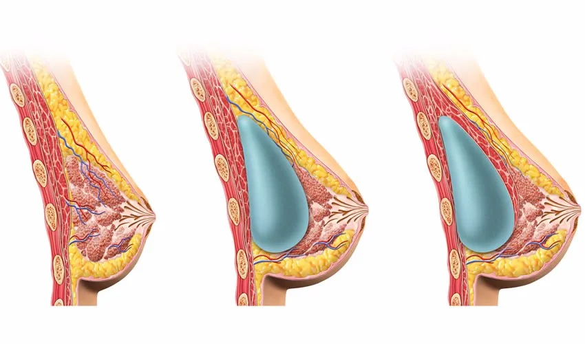 otesaly 注射型真皮填充剂 10毫升臀部注射丰胸透明质酸 - buy breast