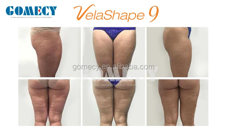 Vertical V Shape 3 Velashape III V9 III auto roller vacuum rf fat removal system for weight loss infrared LED light.jpg