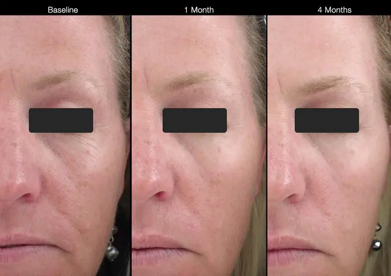 Аллергия на крем с ретинолом как выглядит Source Private Label Aangepaste En Gepersonaliseerde Gezicht Intieme Whitening S