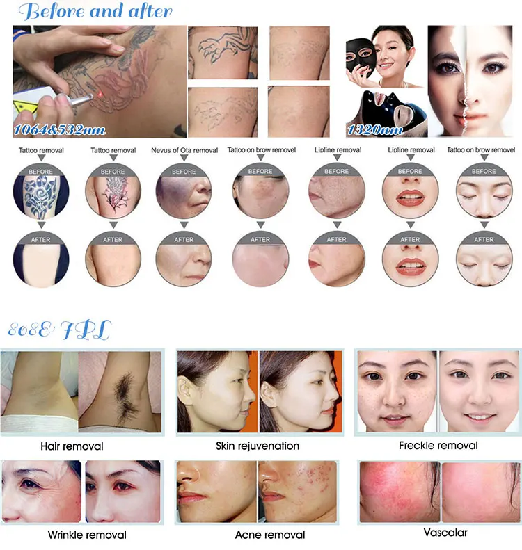 2019 New Multi functional 3 Handles Diode Laser IPL RF Yag Laser Beauty Equipment For Skin Hair Removal Tattoo Removal