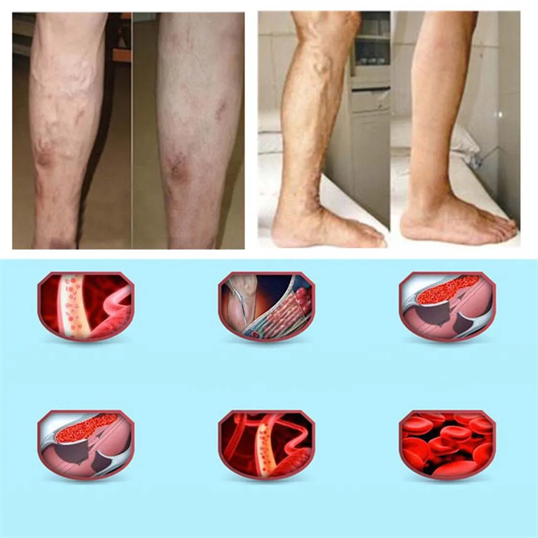 Ce operații sunt efectuate pentru varice la nivelul picioarelor?