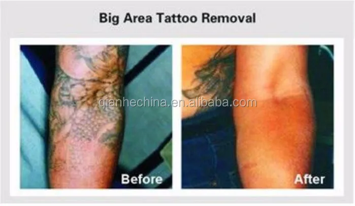 2000mj q switch nd yag laser tattoo removal system rejuvi tattoo 2000mj q switch nd yag laser tattoo removal system rejuvi tattoo