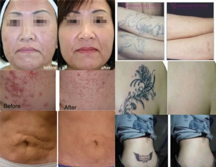 ce certificate portable low cost yag laser tattoo machine od ce certificate portable low cost yag laser tattoo machine od