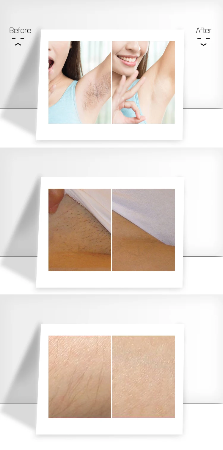 Diode laser 808nm machine