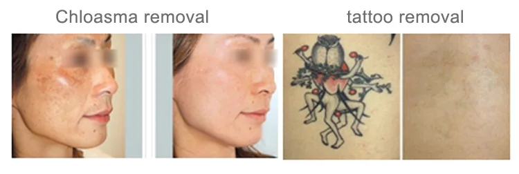 KES multi-functional beauty equipment discovery pico tattoo removal/all skin tattoo removal/tattoo remove nano laser