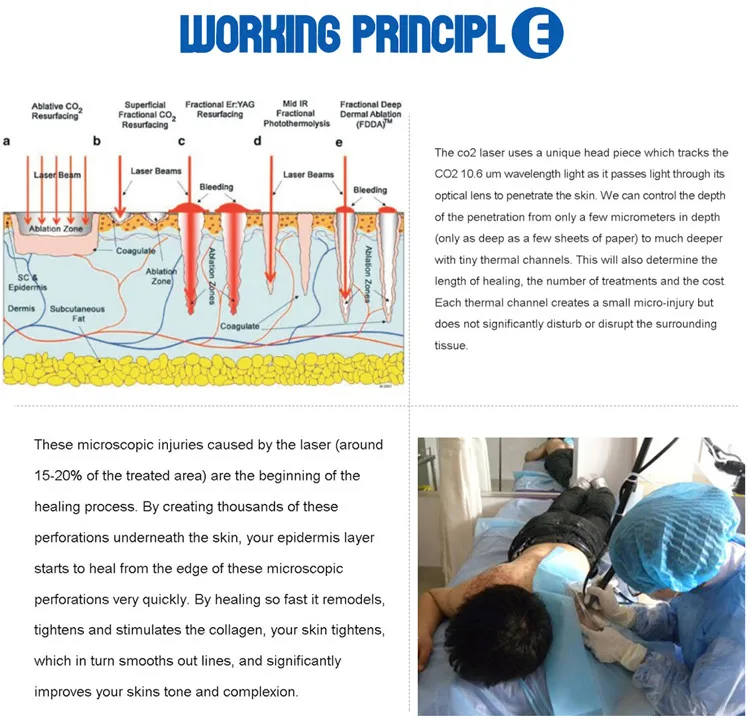 Vaginal Tighten Beautify vagina rf fractional co2 laser portable machine