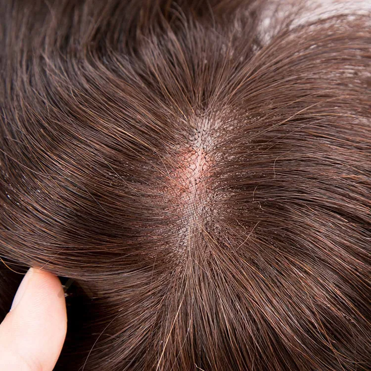 Топ 10 вопросов о системах замещения волос при алопеции