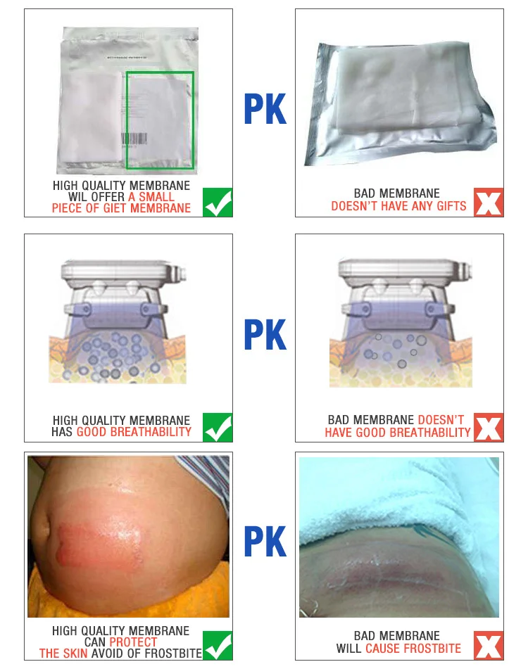 Criolipolise antifreeze membrane for LipoFreeze