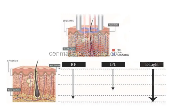 IPL RF work.jpg