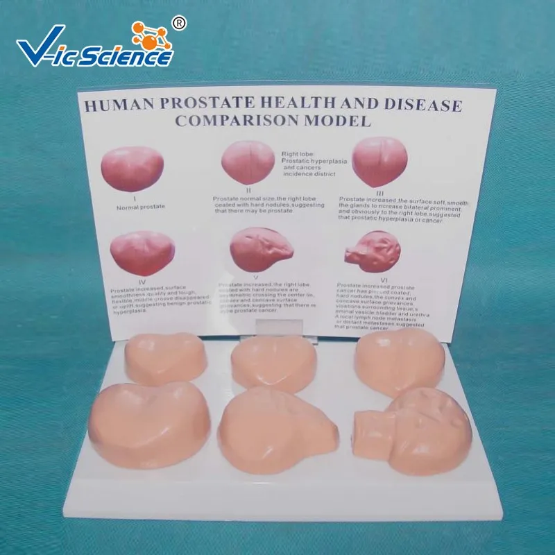 Medical Science Human Prostate Lesion Anatomical Model the Diseased ...