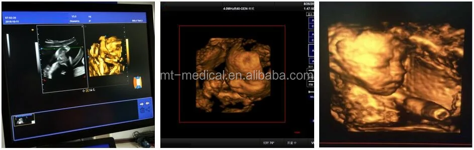 Ultrasound Medical Equipment C-90 3.0 4D Ultrasound Machine