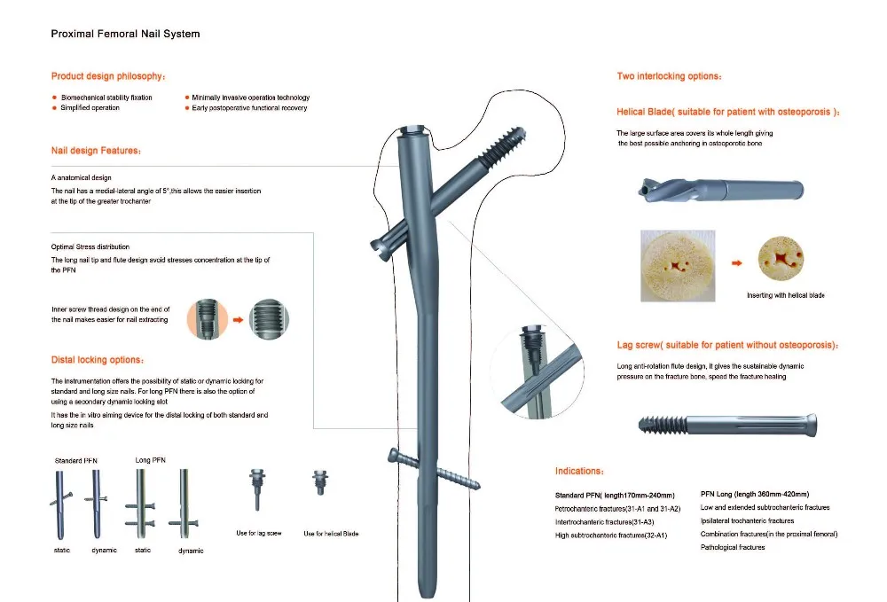 Titanium Femoral Nail Extended Pfna Orthopedic Implants Interlocking