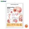 Licensed Educational Plastic 3D Medical Anatomical Wall Chart /Poster - Understanding Stroke