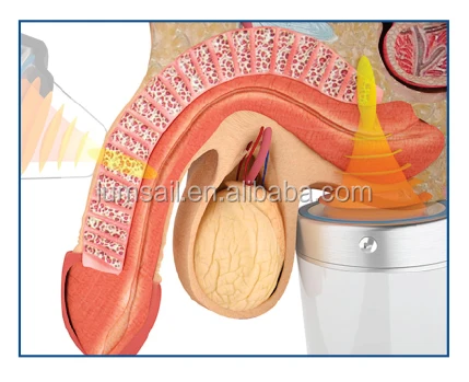 extracorporeal shock wave therapy erectile dysfunction treatment machine