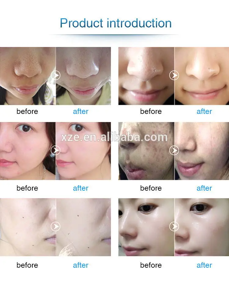 oxygen facial machine 9.jpg