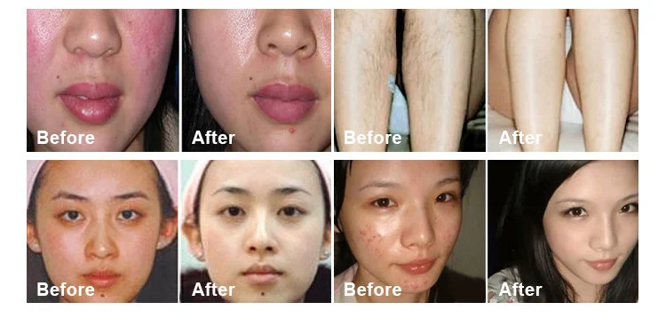 ipl opt shr hair removal hair removal machine