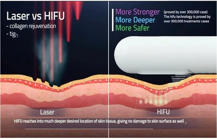 the most effective hifu vaginal tightening machine skin rejuvenation beauty machine