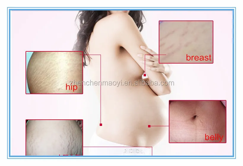 The Newest After Pregnancy Cream Stretch Mark Removal Cream View Removal Cream Product Details From Foshan Zhenchen Trading Co Ltd On Alibaba Com