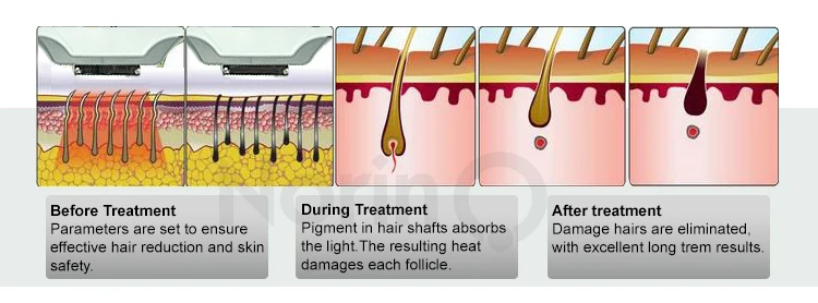 ipl hair removal.jpg