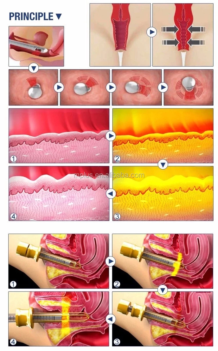 Best Selling Co2 Medical Laser / Co2 Medical Laser Machine / Fractional Co2 Laser skin lifting