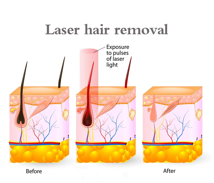 Laser hair removal machine 808nm diode laser diode 808 hair removal