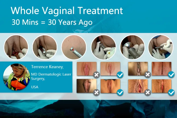 co2 lasers for vaginal surgery Hardcore on the mat