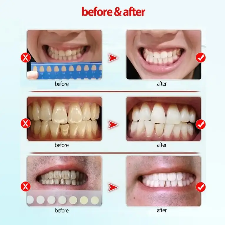 How To Use Carbamide Peroxide Teeth Whitening Teeth Poster