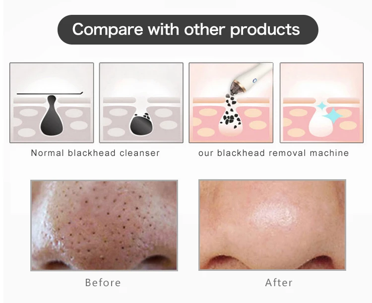 blackhead remover (5).jpg