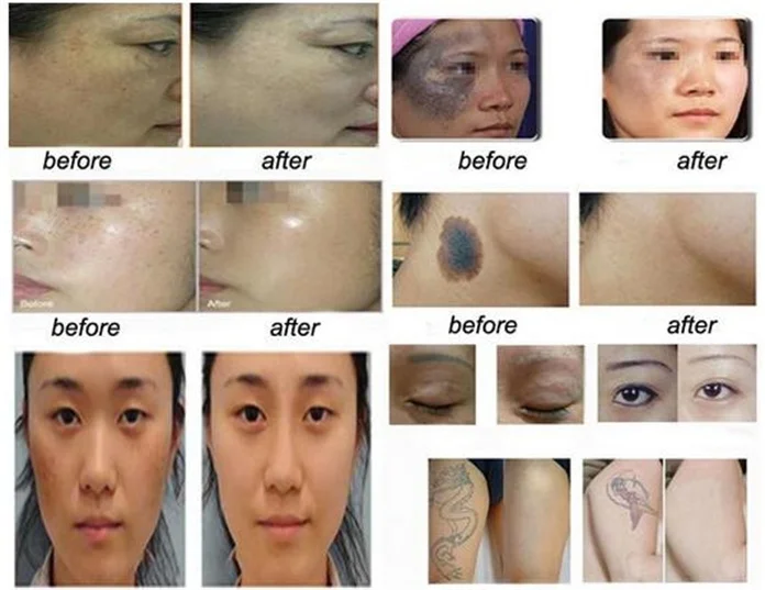 Picosecond tattoo remove.JPG