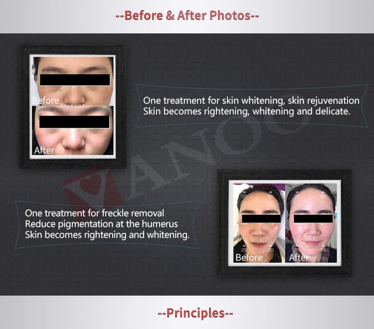 Carbon laser peeling machine /pico second laser tattoo removal pigmentation removal skin rejuvenation