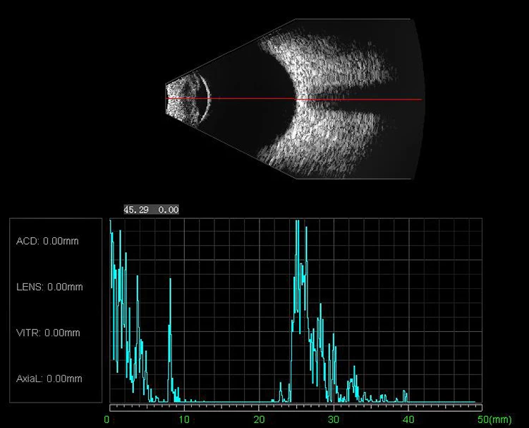 Transducer arrays Ophthalmic Ultrasound Scan Machine Medical Equipment A/b Scan Cas