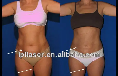 lipo thigh 3
