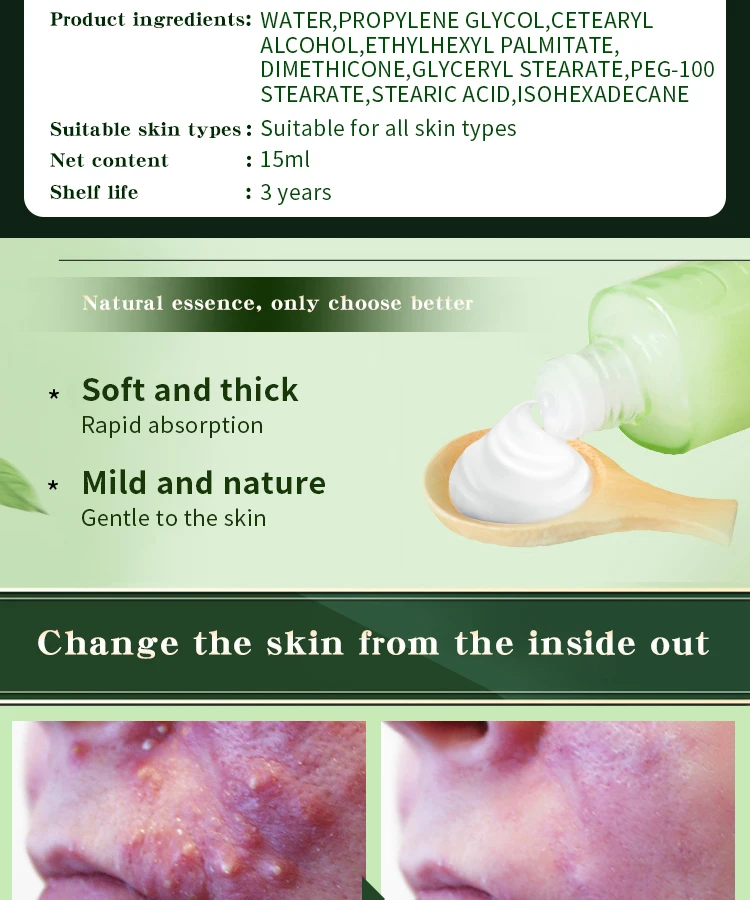 acne away cream